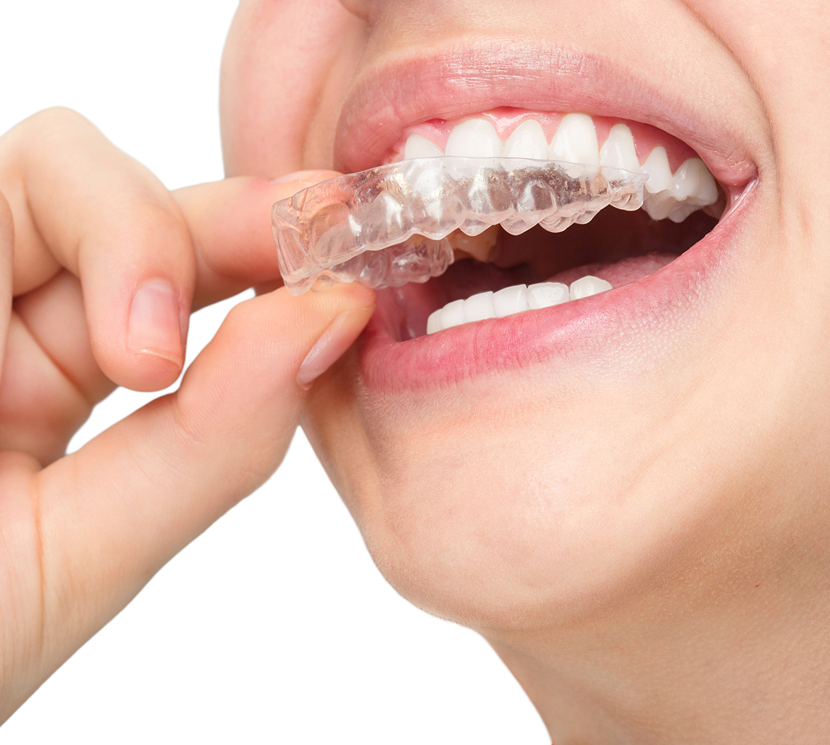 invisalign